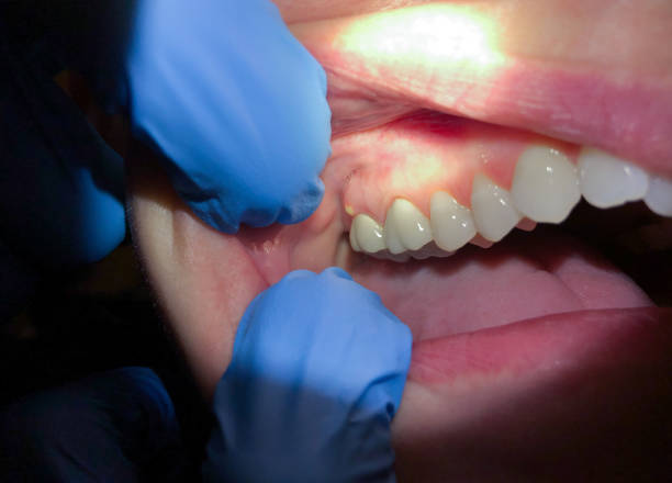 Best Emergency Root Canal Treatment in Arnold, MD